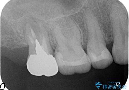 オールセラミッククラウン　虫歯治療・再根管治療の治療前