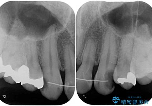 矯正治療後のセラミッククラウンの治療前