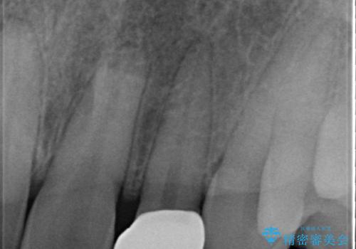 オールセラミッククラウン 部分矯正の治療後