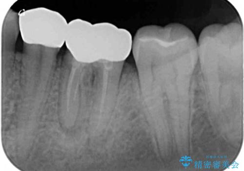 深い虫歯で歯茎が腫れる　部分矯正を用いたむし歯治療の治療後