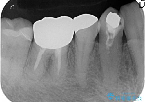 オールセラミッククラウン　再根管治療後の補綴の治療前