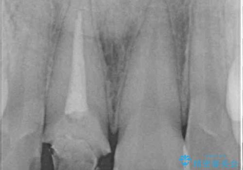 銀歯を白くしたい セラミックによる審美歯科治療の治療前
