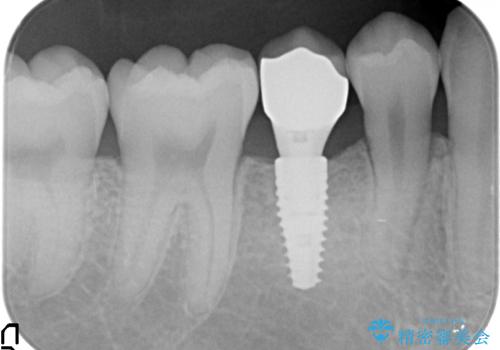 20代男性　奥歯のインプラント　自分の骨を移植の治療後