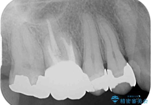 痛くてかめない 根管治療とオールセラミッククラウンの治療後