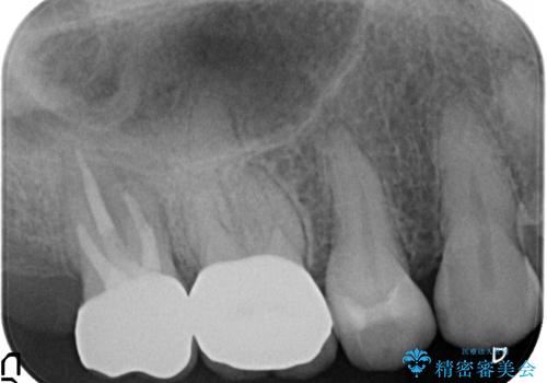 オールセラミッククラウン　虫歯治療・再根管治療の治療後