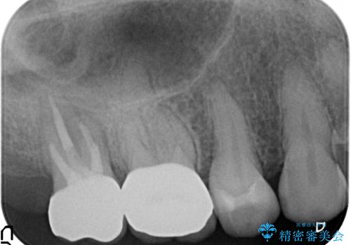 オールセラミッククラウン 虫歯治療・再根管治療の治療後