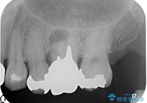 オールセラミッククラウン 抜歯になった奥歯の欠損補綴の治療前