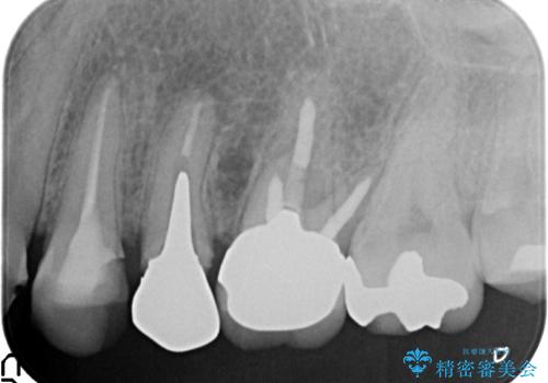 オールセラミッククラウン 根管治療のやり直しの治療前