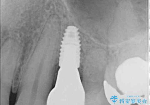 割れてしまった小臼歯 インプラントによる補綴治療の治療後