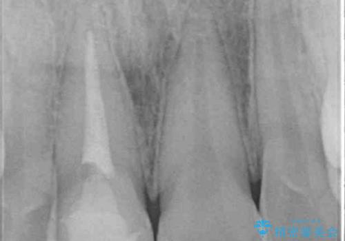 銀歯を白くしたい セラミックによる審美歯科治療の治療後