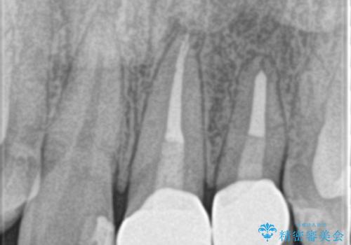 外れそうで不適合のかぶせ物の根管治療からの再治療の治療後