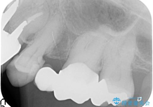 オールセラミッククラウン 不安定なブリッジの再補綴の治療前