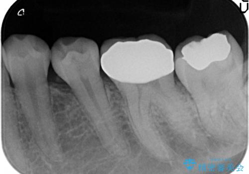 オールセラミッククラウン 知覚過敏の治療の治療後