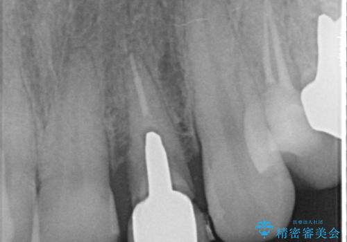 オールセラミッククラウン 根管治療のやり直しの治療前
