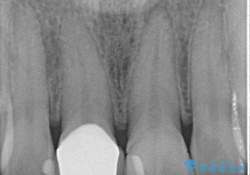 歯が折れた セラミックで綺麗に 30代女性の治療後