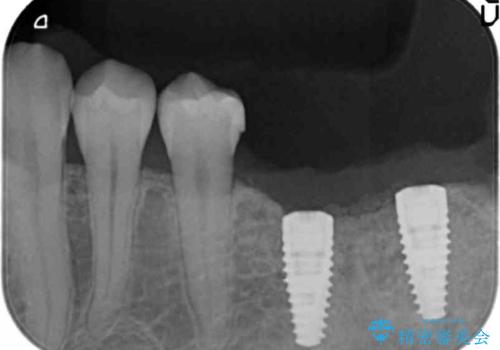 他院で断られた骨造成を伴うインプラント治療の治療中