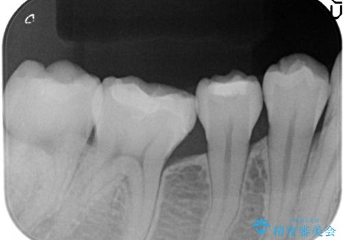 セラミックインレー 銀歯から白い歯への治療後