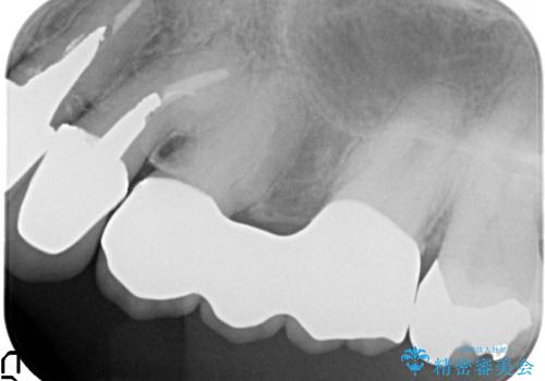 オールセラミッククラウン 不安定なブリッジの再補綴の治療後