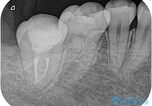 【根管治療】ズキズキ痛い歯の治療後