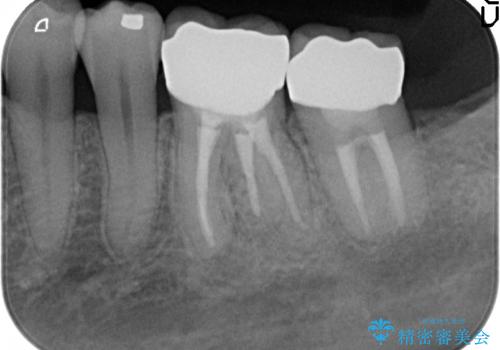 オールセラミッククラウン　激しく痛む歯の再根管治療の治療後