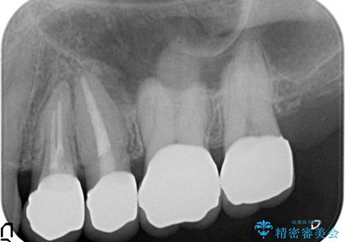 オールセラミッククラウン 銀歯を白くの治療後