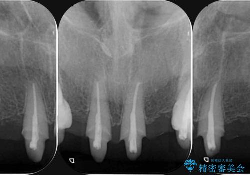不自然な前歯ブリッジ ジルコニアブリッジによるやり替えの治療中