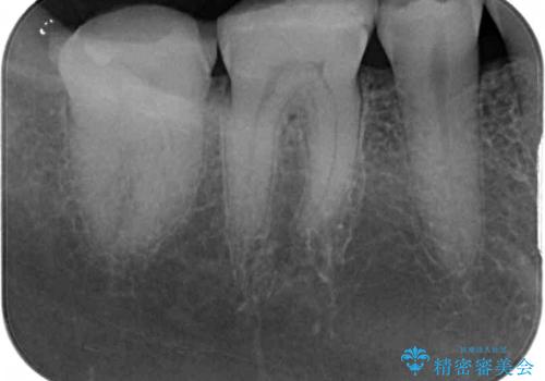 奥歯の壊れたり汚れたりしたクラウン オールセラミッククラウンによる審美歯科治療 の治療前