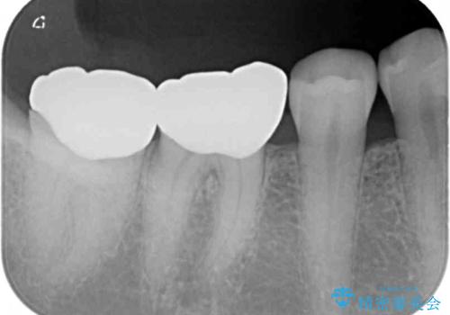 奥歯の壊れたり汚れたりしたクラウン　オールセラミッククラウンによる審美歯科治療　の治療後