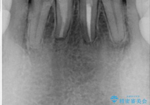 下の前歯の色が気になる セラミックで綺麗に 40代男性の治療後