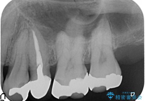 オールセラミッククラウン 銀歯を白くの治療前