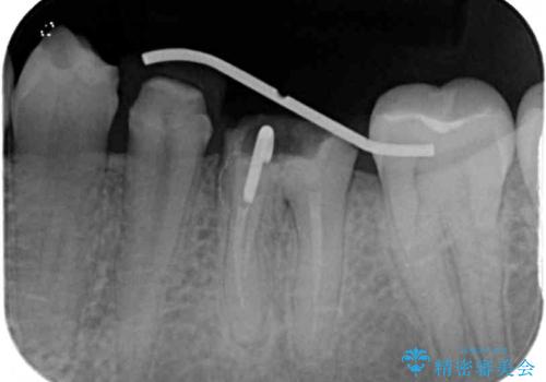 深い虫歯で歯茎が腫れる　部分矯正を用いたむし歯治療の治療中