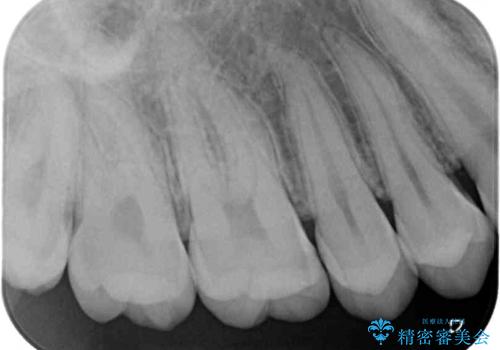 フロスが引っかかる セラミックインレーによるむし歯治療の治療前