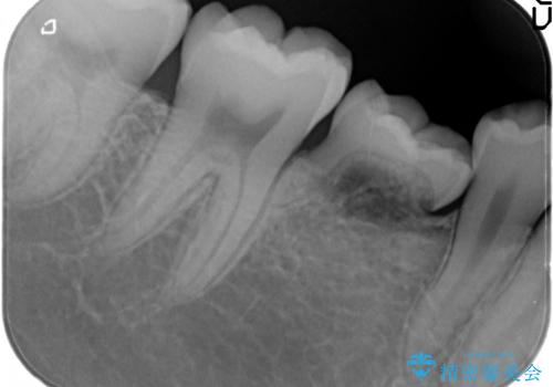 20代男性　奥歯のインプラント　自分の骨を移植の治療前