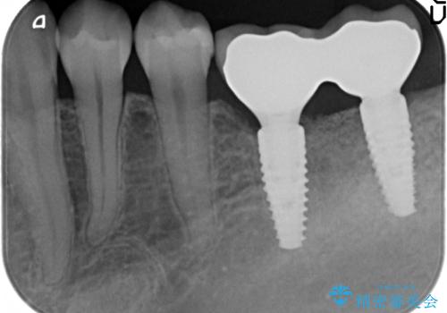 他院で断られた骨造成を伴うインプラント治療の治療後