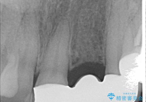 オールセラミッククラウン 根管治療のやり直しの治療後