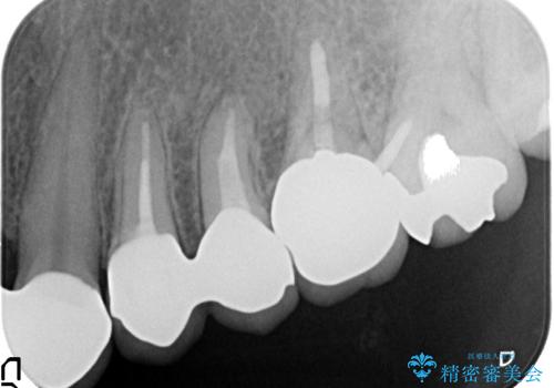 オールセラミッククラウン 根管治療のやり直しの治療後