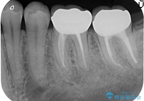 オールセラミッククラウン 咬むと痛む奥歯の治療の治療後