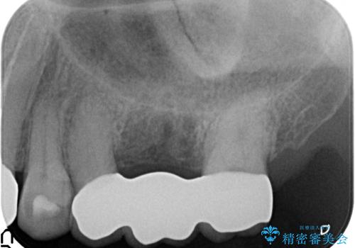 オールセラミッククラウン 抜歯になった奥歯の欠損補綴の治療後