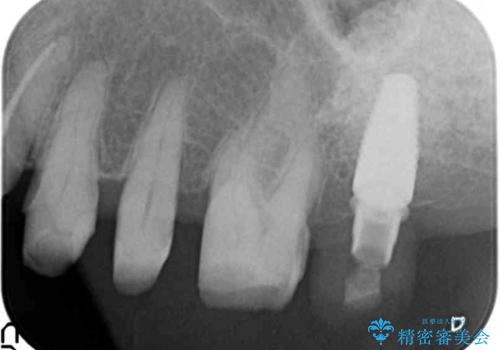 歯ぎしりに抵抗する歯周補綴 インプラント補綴の治療中