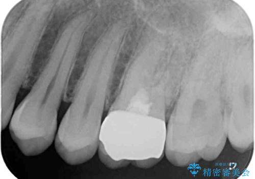 他院で神経を取ると言われた 神経を極力残した虫歯治療の治療後
