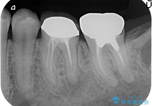 オールセラミッククラウン 咬むと痛む奥歯の治療の治療前