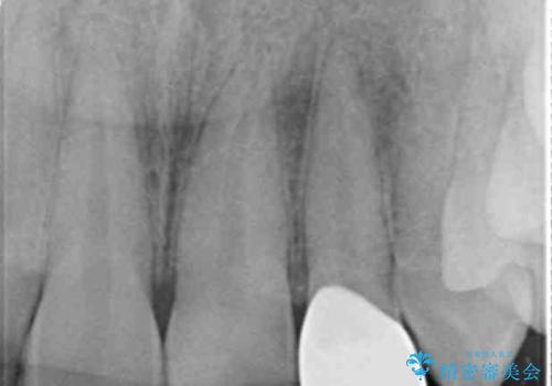 割れにくいセラミック治療 フルジルコニアクラウンの治療後