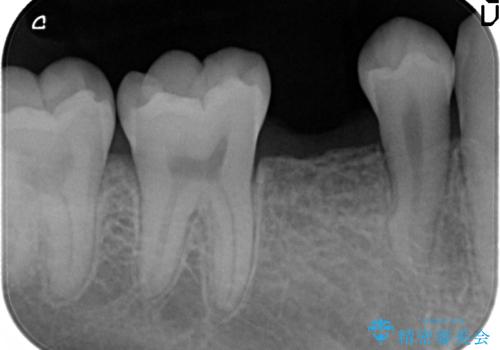 20代男性 奥歯のインプラント 自分の骨を移植の治療中