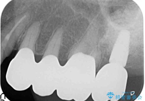 歯ぎしりに抵抗する歯周補綴 インプラント補綴の治療後