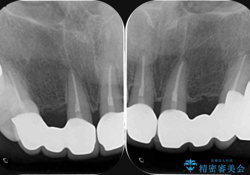 不自然な前歯ブリッジ ジルコニアブリッジによるやり替えの治療後