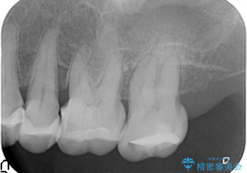 歯ぎしりに抵抗する歯周補綴 インプラント補綴の治療前