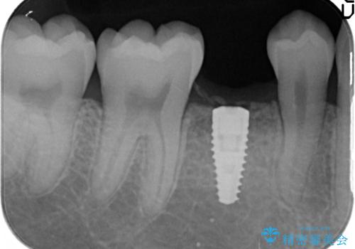 20代男性　奥歯のインプラント　自分の骨を移植の治療中