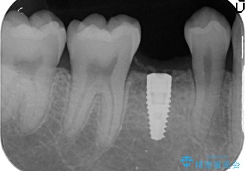 20代男性 奥歯のインプラント 自分の骨を移植の治療中
