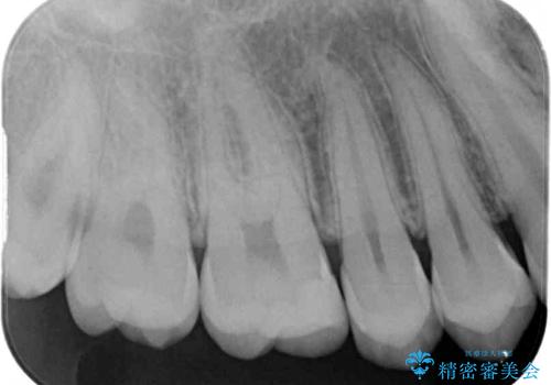 フロスが引っかかる　セラミックインレーによるむし歯治療の治療後