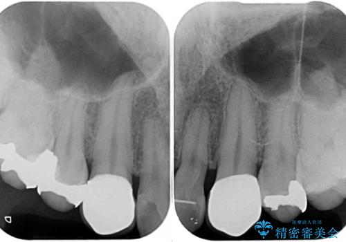 矯正治療後のセラミッククラウンの治療後